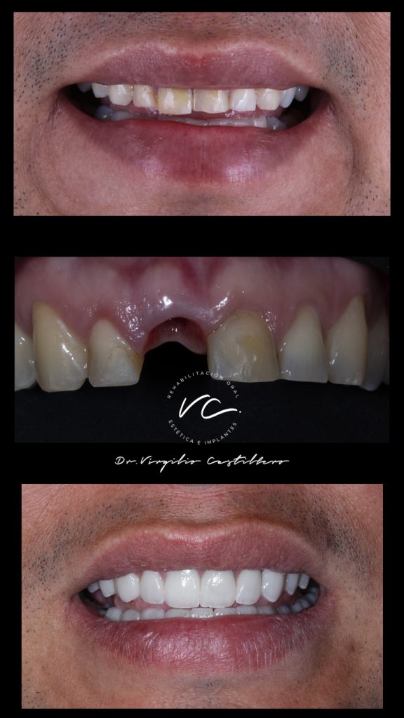 Resultado antes y después de un tratamiento de implantes dentales realizado por el Dr. Virgilio Castillero en Panamá.