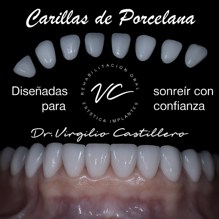 Carillas de porcelana exclusivas desde Dubái – Caso 1 del Dr. Virgilio Castillero en Panamá