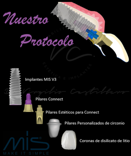 Esquema del protocolo clínico del Dr. Virgilio Castillero para implantes dentales en Panamá, con diagnóstico digital, cirugía guiada y rehabilitación protésica