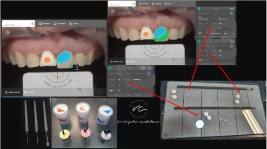 Proceso de personalización de porcelana dental con eLab para lograr un color exacto en el paciente.