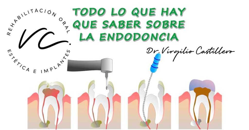 Ilustración explicativa sobre endodoncia por el Dr. Virgilio Castillero, especialista en rehabilitación oral, estética e implantes.