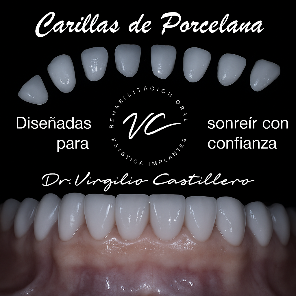 Carillas de porcelana exclusivas desde Dubái – Caso 1 del Dr. Virgilio Castillero en Panamá