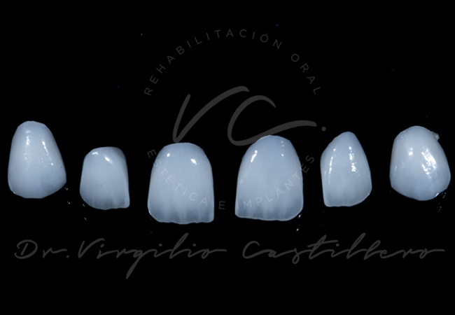 Carillas de porcelana exclusivas desde Dubái – Caso 3 del Dr. Virgilio Castillero en Panamá
