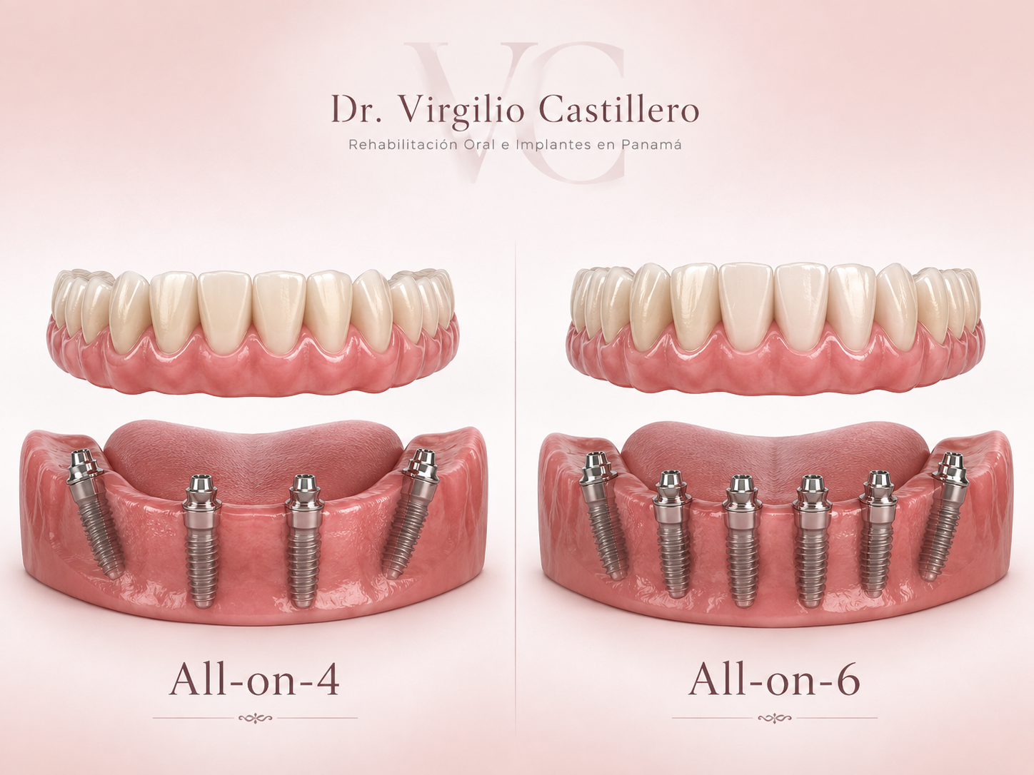 All-on-X dental implants in Panama